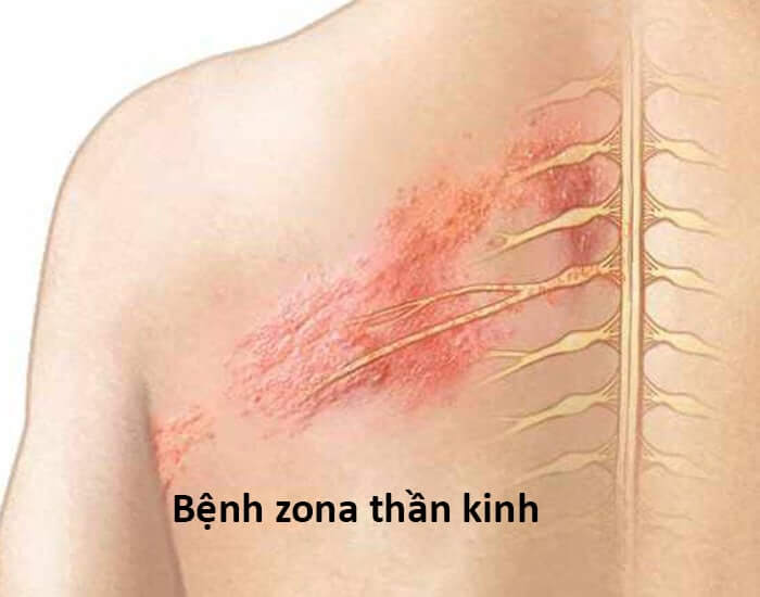 Bài thuốc dân gian chữa bệnh zona thần kinh