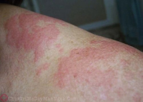 Bị phát ban đỏ trên da do viêm da tiếp xúc