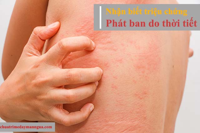 Triệu chứng phát ban do thời tiết