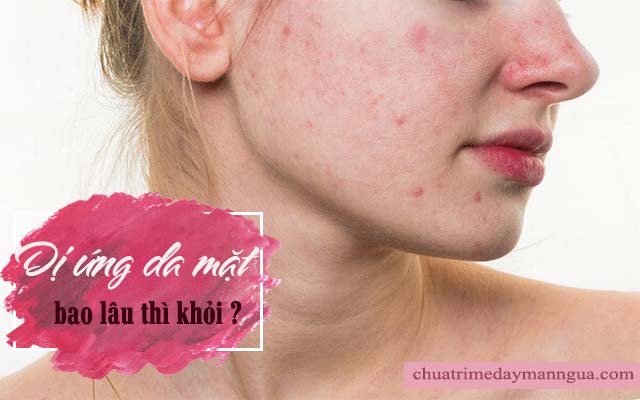 Dị ứng da mặt bao lâu thì khỏi?