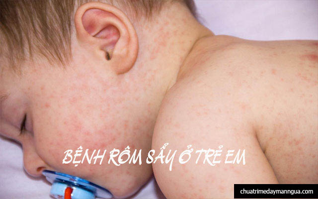 Căn bệnh ngoài da ở trẻ em