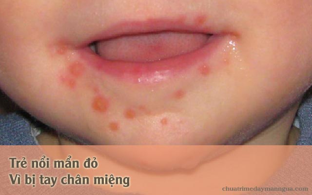 trẻ bị nổi mẩn đỏ do bệnh tay chân miệng