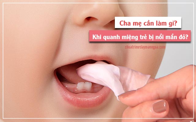 cần làm gì để bé hết bị mẩn đỏ quanh miệng