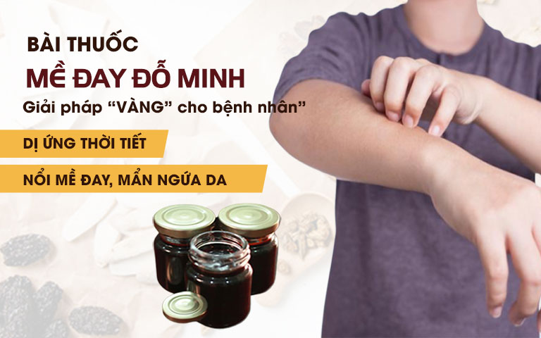 Mề đay Đỗ Minh - Bài thuốc 150 năm tuổi chữa DỨT ĐIỂM mọi chứng bệnh mề đay mẩn ngứa