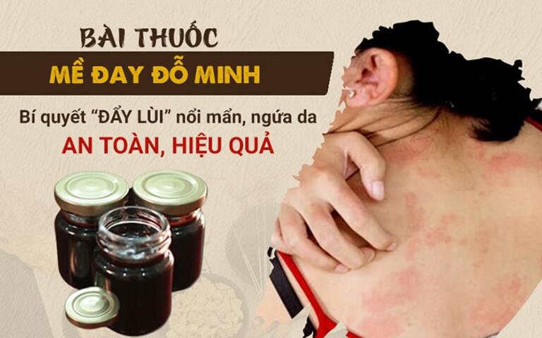 Mề đay Đỗ Minh - Phương thuốc BÍ TRUYỀN dòng họ Đỗ Minh