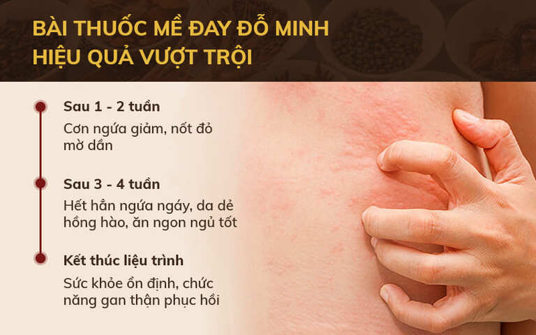 Những chuyển biến của mình qua từng giai đoạn điều trị bằng thuốc Mề đay Đỗ Minh